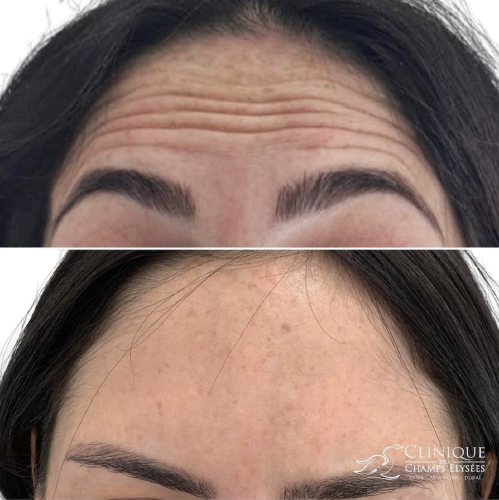 Before/after BOTOX front lines