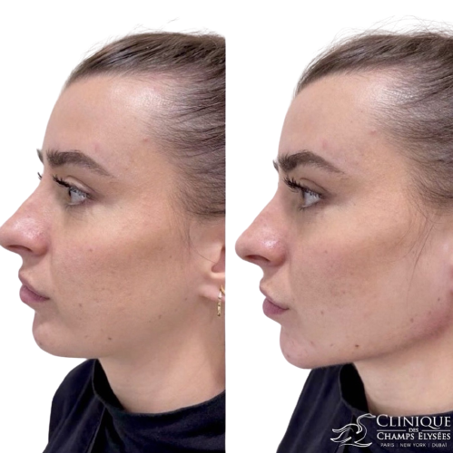 before/after jawline contouring