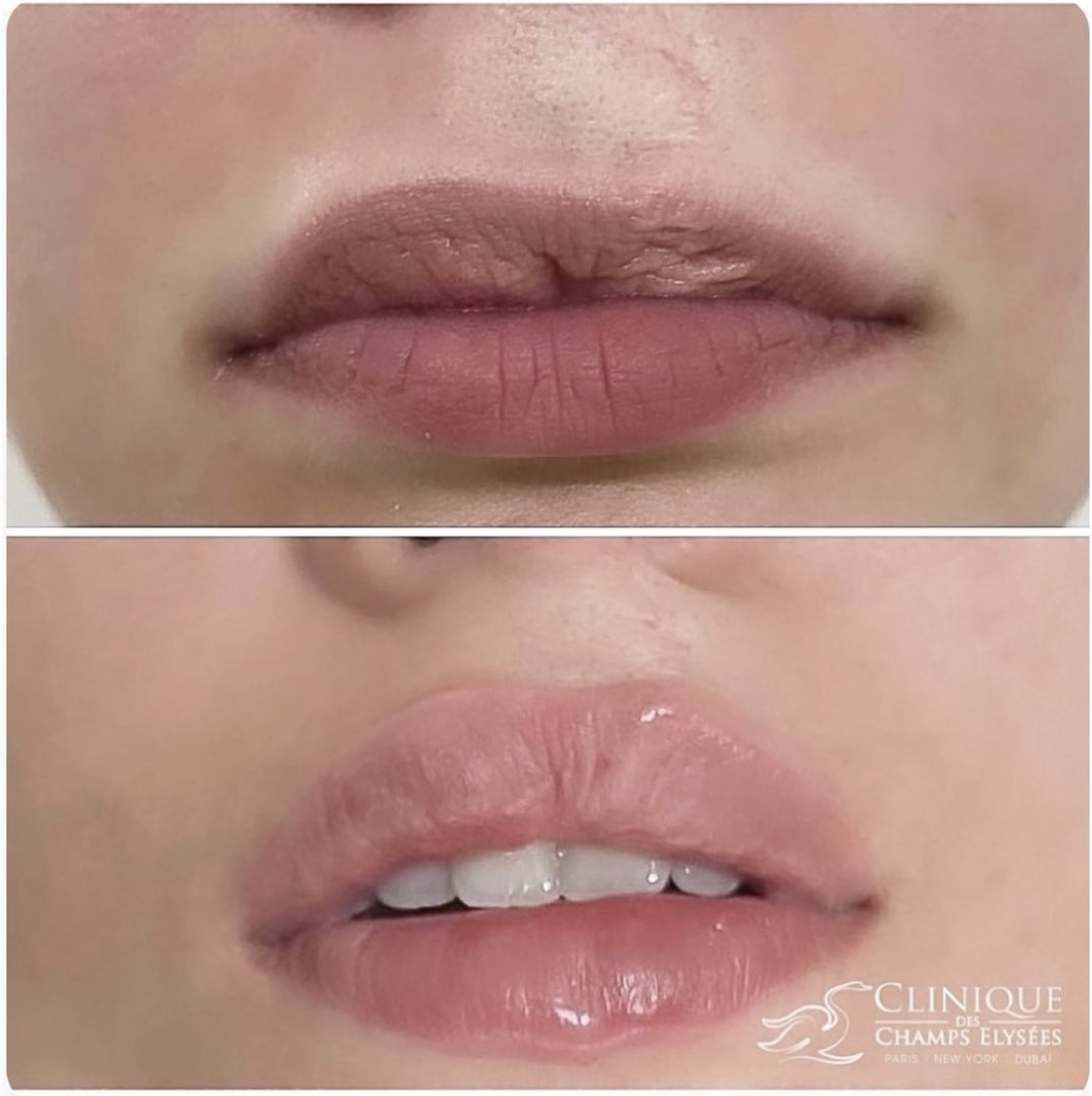 before/after lip fillers