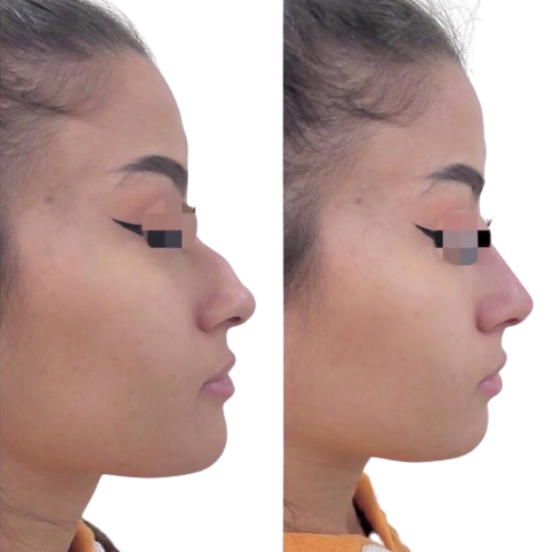 before/after liquid rhinoplasty